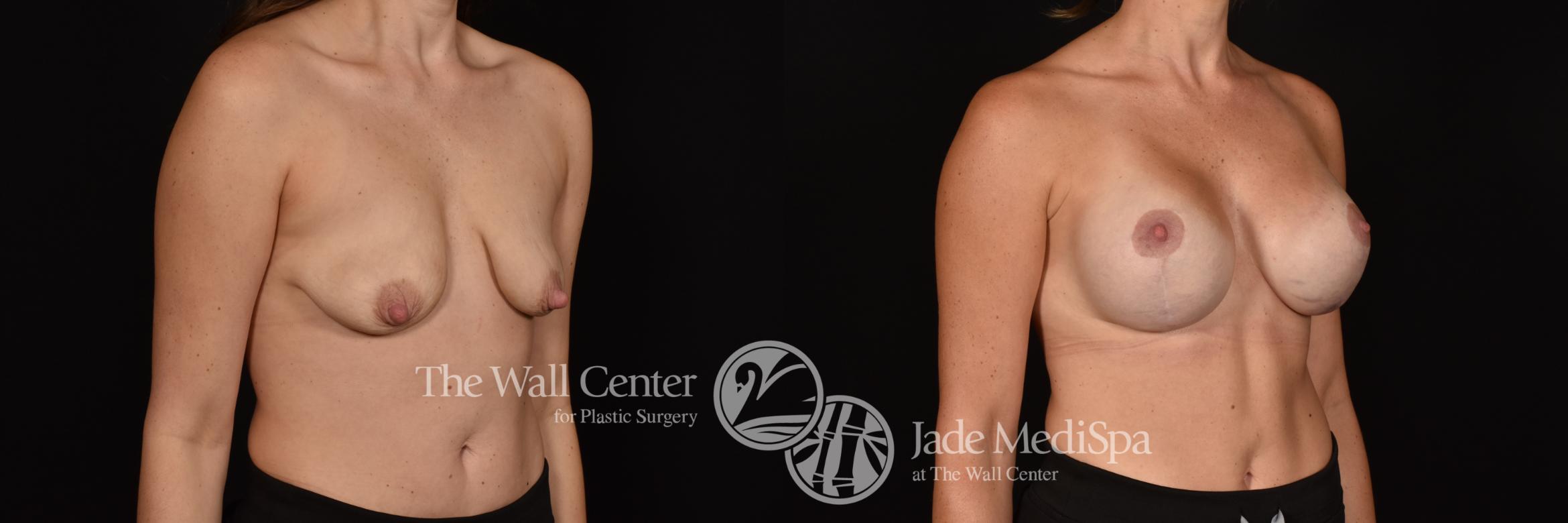Before & After Breast Augmentation with Lift Case 1129 Right Oblique View in Shreveport, LA