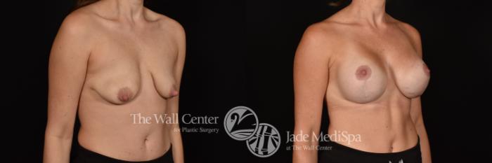 Before & After Breast Augmentation with Lift Case 1129 Right Oblique View in Shreveport, LA