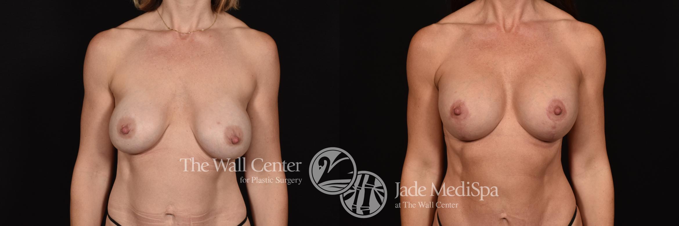 Before & After Breast Augmentation with Lift Case 1131 Front View in Shreveport, LA