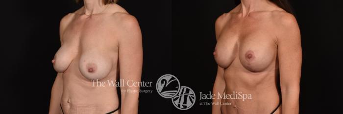 Before & After Breast Augmentation with Lift Case 1131 Left Oblique View in Shreveport, LA