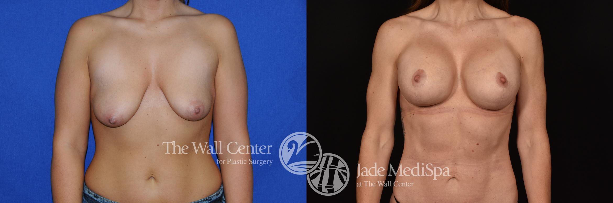 Before & After Breast Augmentation with Lift Case 1138 Front View in Shreveport, LA