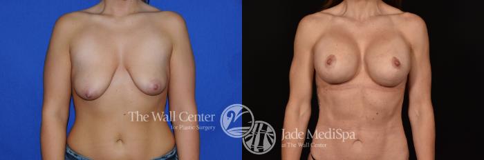 Before & After Breast Augmentation with Lift Case 1138 Front View in Shreveport, LA