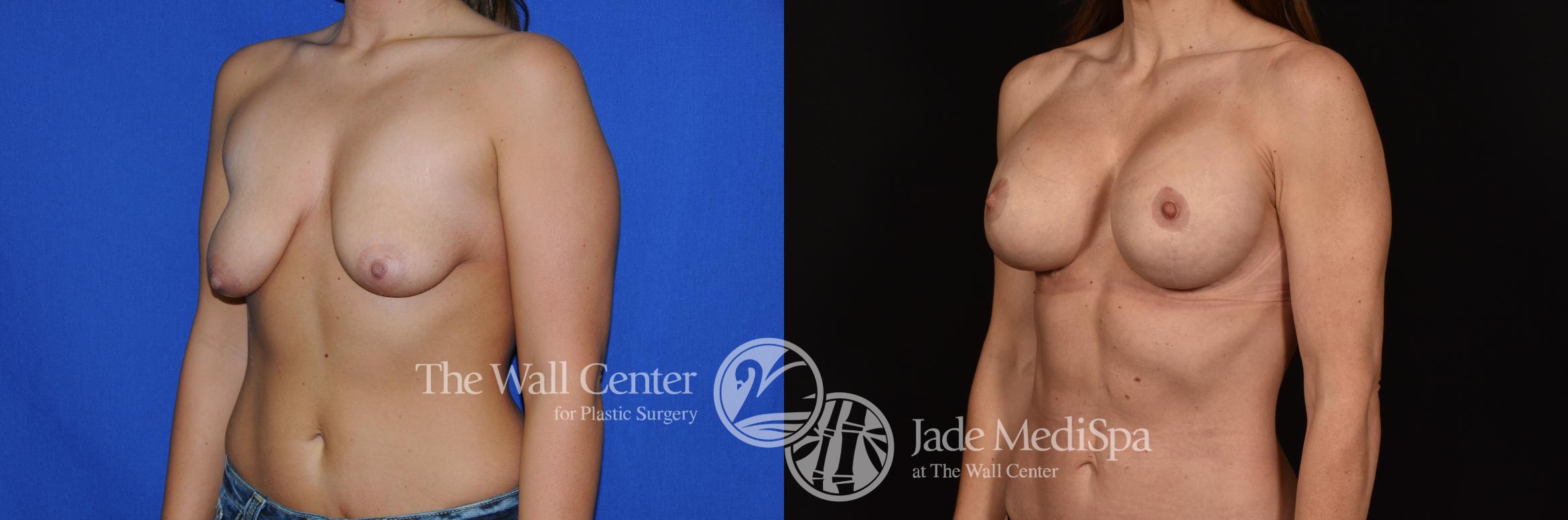 Before & After Breast Augmentation with Lift Case 1138 Left Oblique View in Shreveport, LA