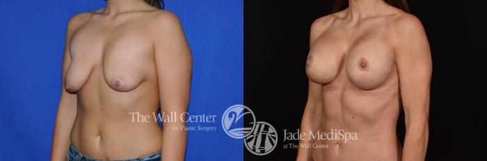 Before & After Breast Augmentation with Lift Case 1138 Left Oblique View in Shreveport, LA