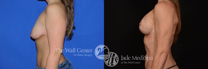 Before & After Breast Augmentation with Lift Case 1138 Left Side View in Shreveport, LA