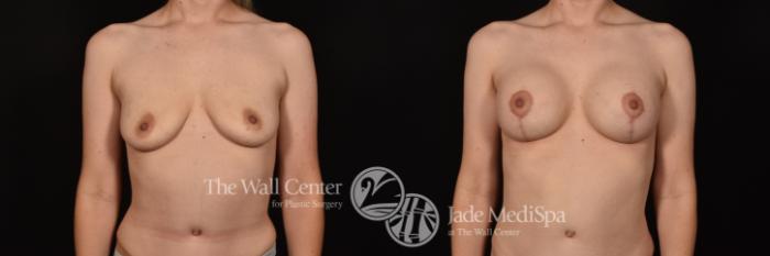 Before & After Breast Augmentation with Lift Case 1141 Front View in Shreveport, LA