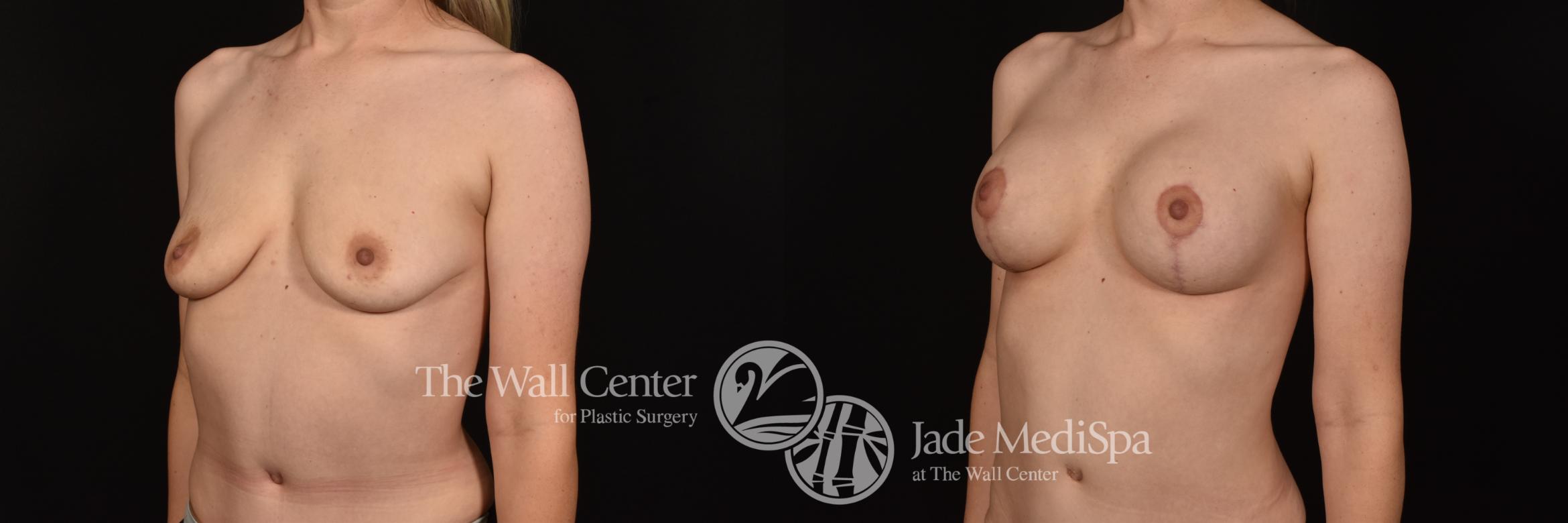 Before & After Breast Augmentation with Lift Case 1141 Left Oblique View in Shreveport, LA