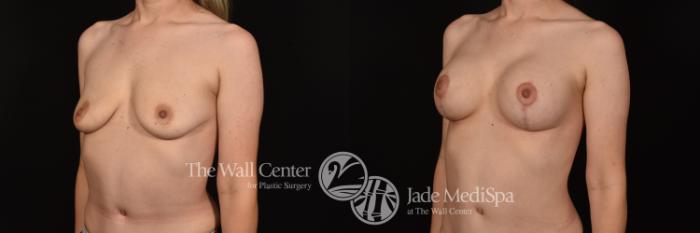 Before & After Breast Augmentation with Lift Case 1141 Left Oblique View in Shreveport, LA