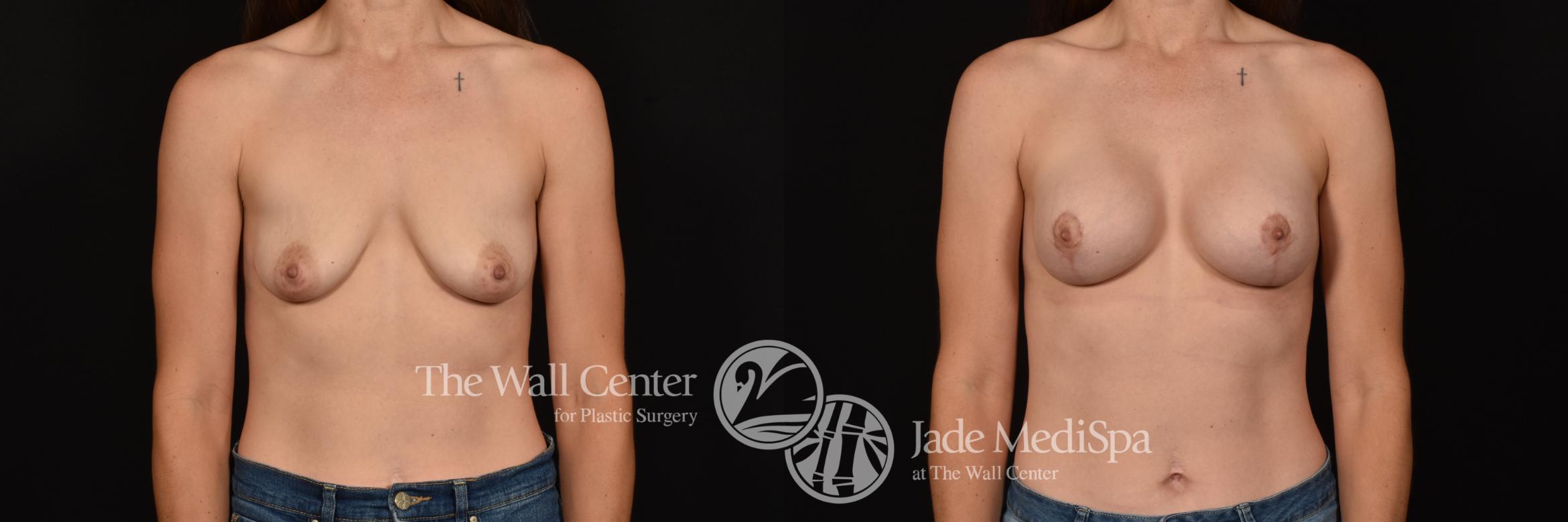 Before & After Breast Augmentation with Lift Case 1143 Front View in Shreveport, LA