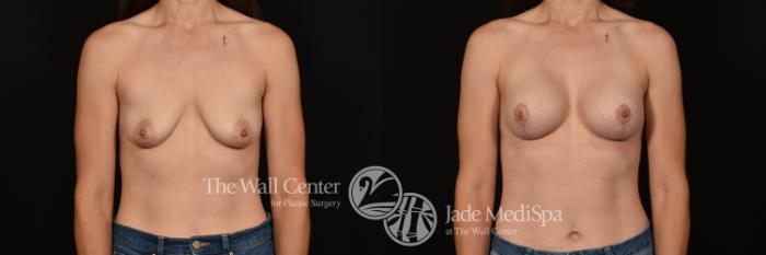 Before & After Breast Augmentation with Lift Case 1143 Front View in Shreveport, LA