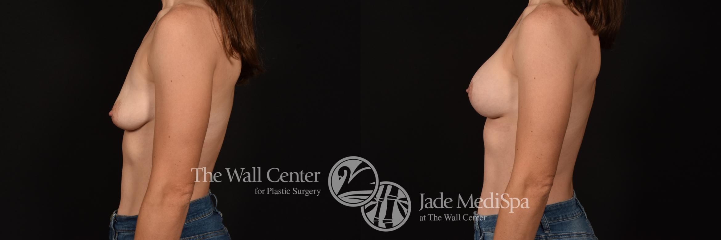 Before & After Breast Augmentation with Lift Case 1143 Left Side View in Shreveport, LA