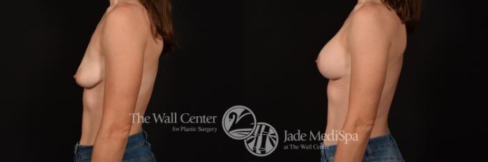 Before & After Breast Augmentation with Lift Case 1143 Left Side View in Shreveport, LA