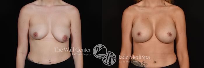 Before & After Breast Augmentation with Lift Case 1145 Front View in Shreveport, LA