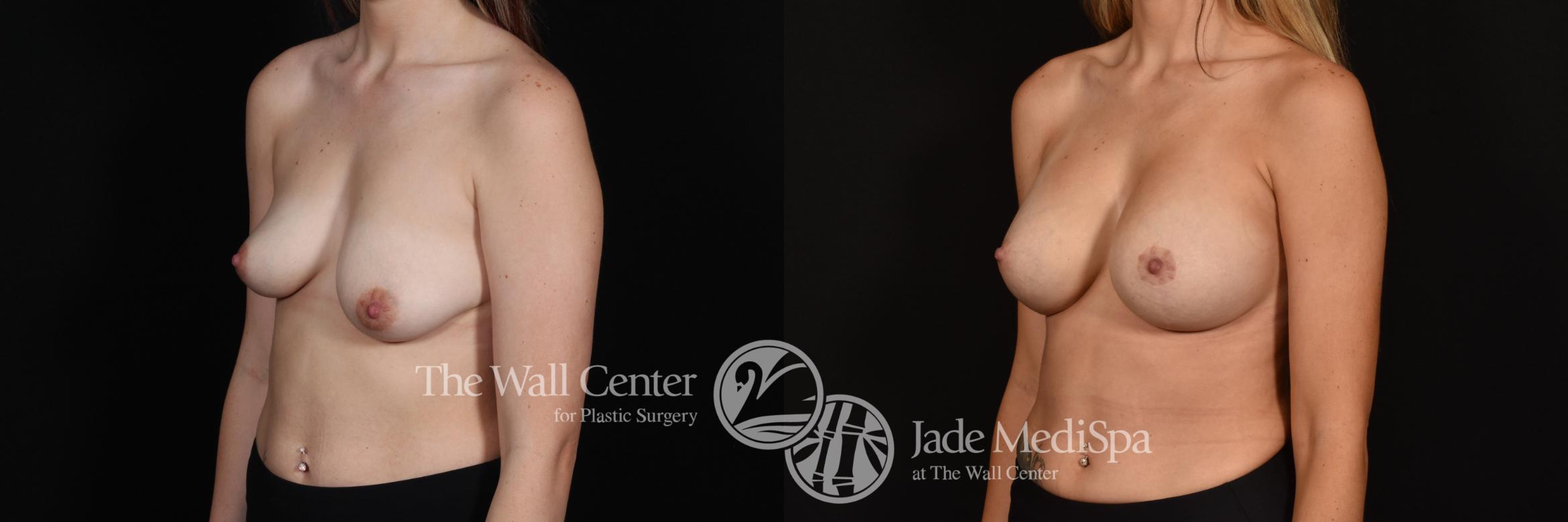 Before & After Breast Augmentation with Lift Case 1145 Left Oblique View in Shreveport, LA