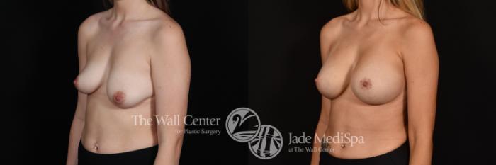 Before & After Breast Augmentation with Lift Case 1145 Left Oblique View in Shreveport, LA