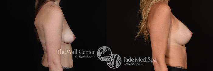 Before & After Breast Augmentation with Lift Case 1145 Right Side View in Shreveport, LA