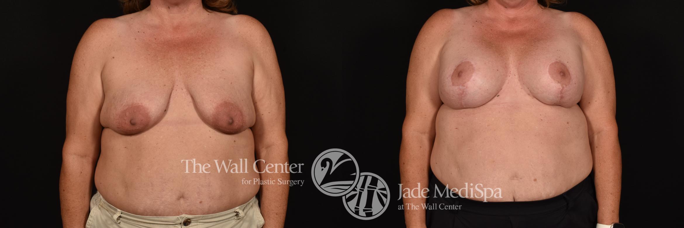 Before & After Breast Augmentation with Lift Case 1168 Front View in Shreveport, LA