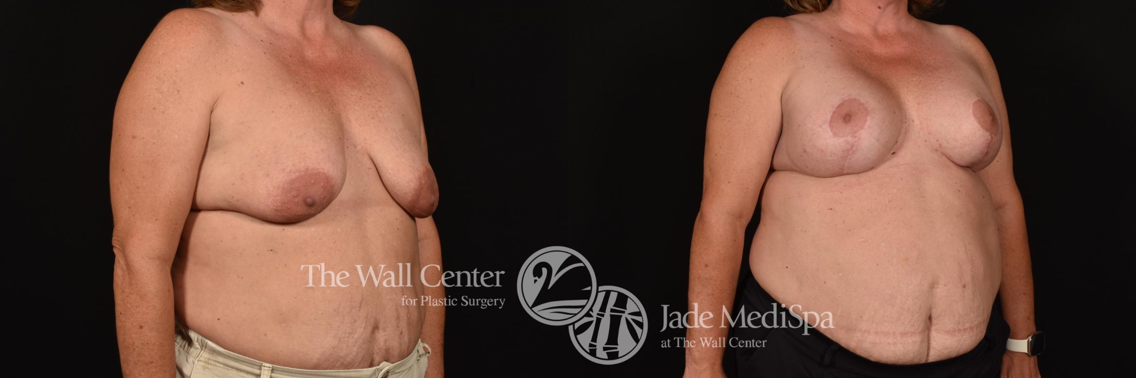 Before & After Breast Augmentation with Lift Case 1168 Right Oblique View in Shreveport, LA