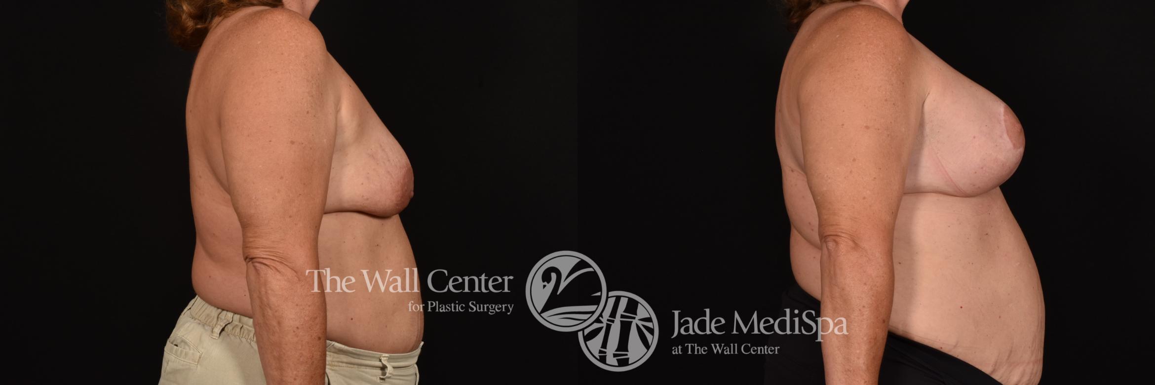Before & After Breast Augmentation with Lift Case 1168 Right Side View in Shreveport, LA