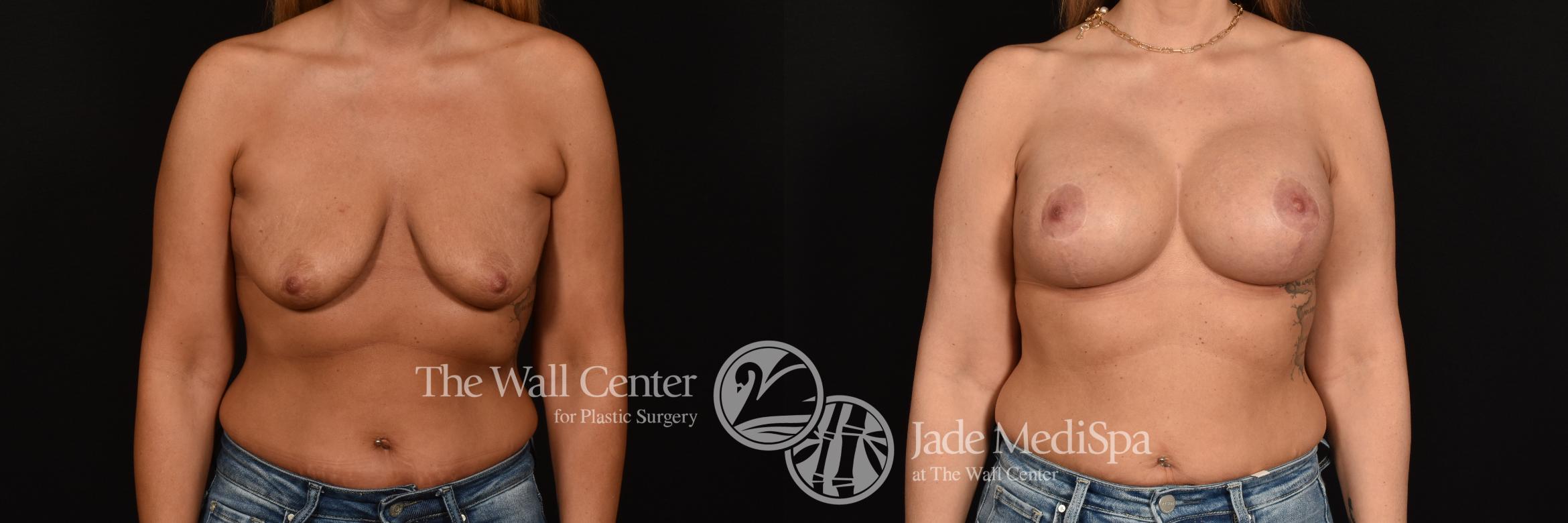 Before & After Breast Augmentation with Lift Case 1175 Front View in Shreveport, LA