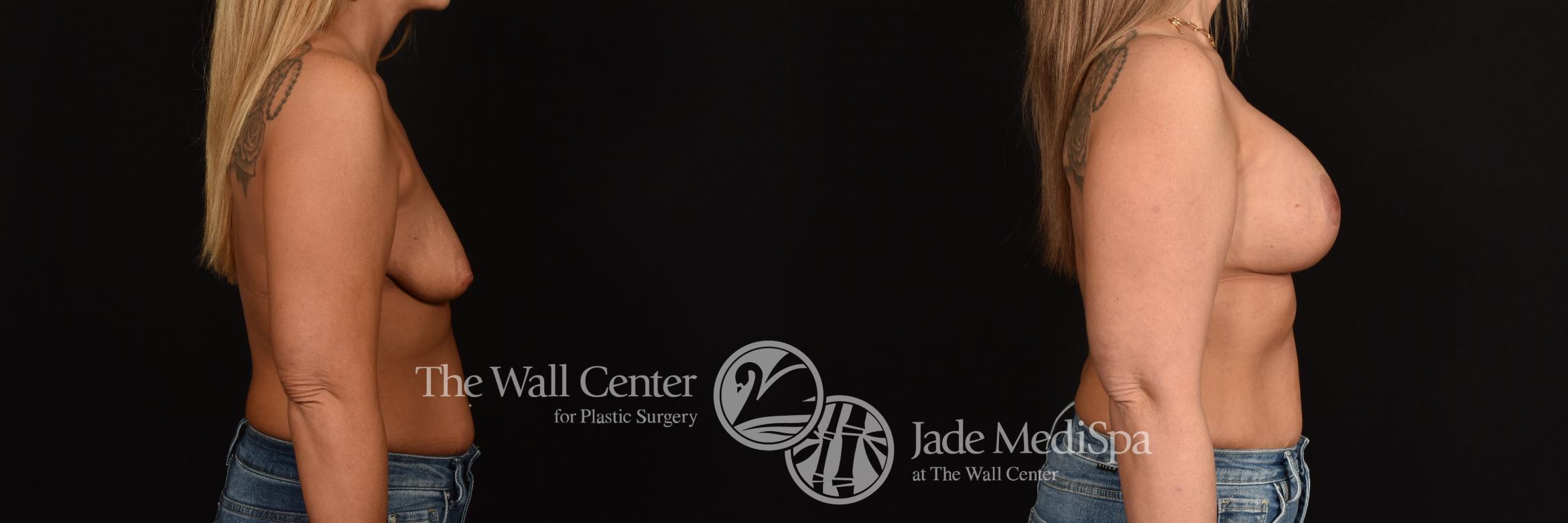 Before & After Breast Augmentation with Lift Case 1175 Right Side View in Shreveport, LA