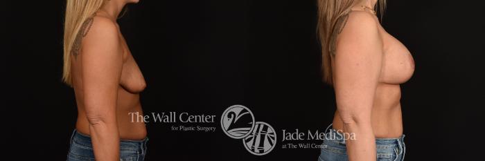 Before & After Breast Augmentation with Lift Case 1175 Right Side View in Shreveport, LA