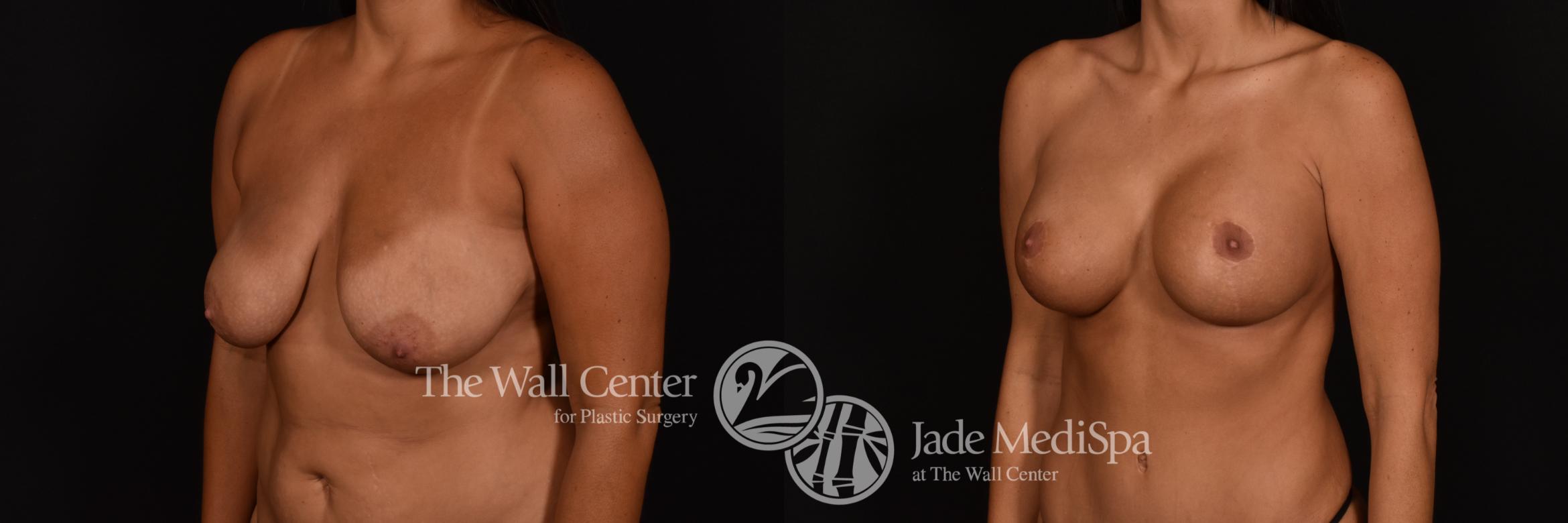 Before & After Breast Augmentation with Lift Case 1186 Left Oblique View in Shreveport, LA