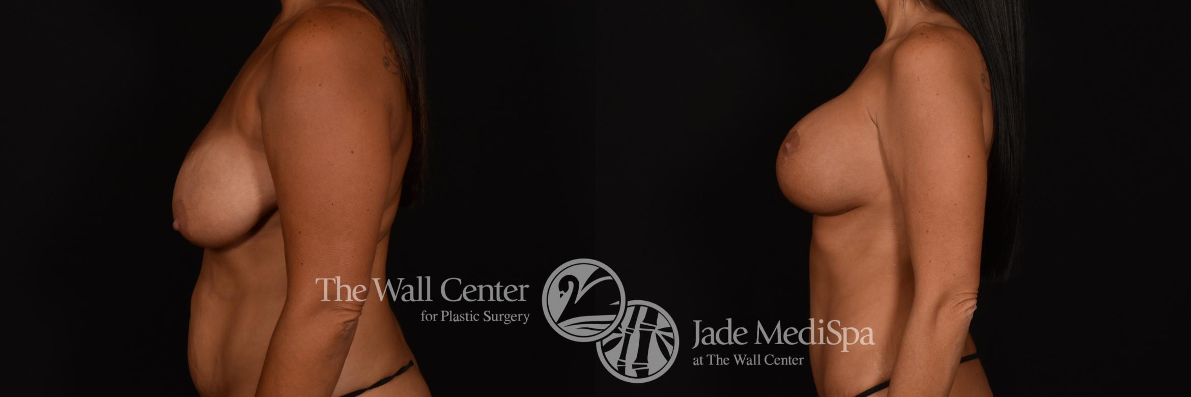 Before & After Breast Augmentation with Lift Case 1186 Left Side View in Shreveport, LA