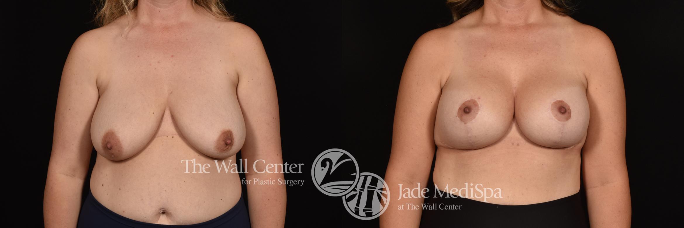 Before & After Breast Augmentation with Lift Case 1188 Front View in Shreveport, LA