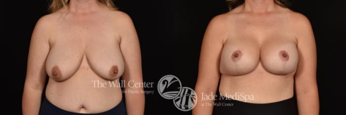 Before & After Breast Augmentation with Lift Case 1188 Front View in Shreveport, LA