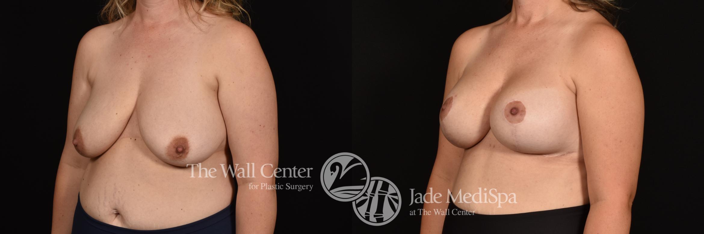 Before & After Breast Augmentation with Lift Case 1188 Left Oblique View in Shreveport, LA