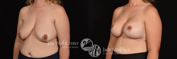 Before & After Breast Augmentation with Lift Case 1188 Left Oblique View in Shreveport, LA