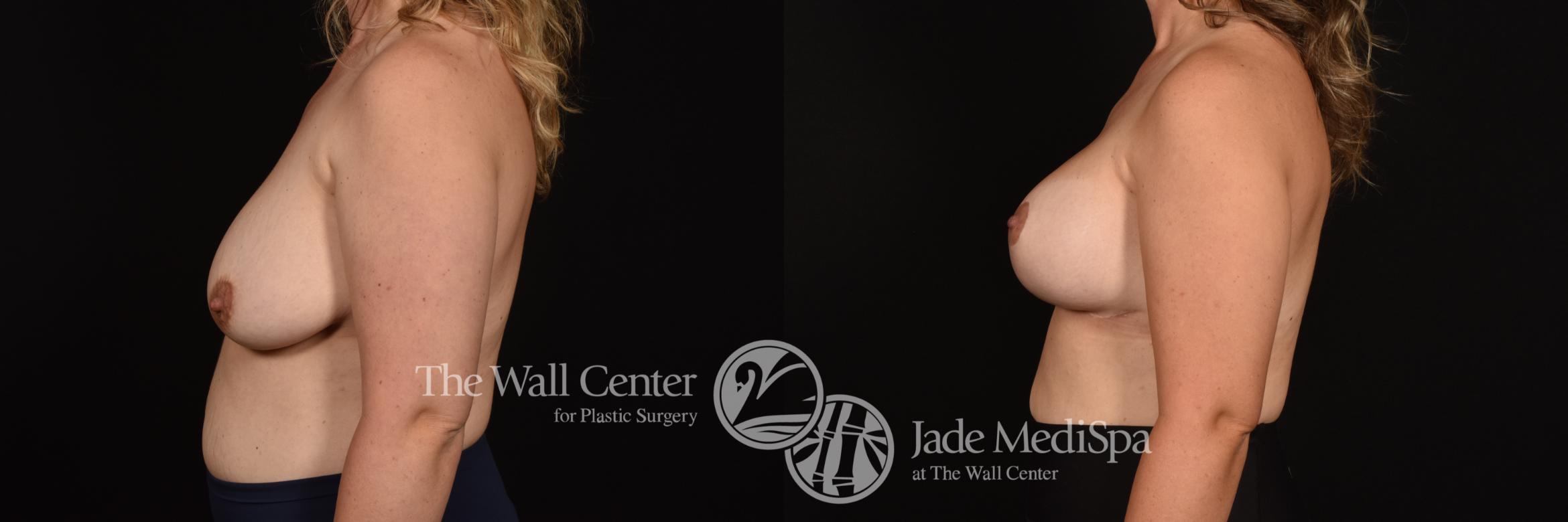 Before & After Breast Augmentation with Lift Case 1188 Left Side View in Shreveport, LA