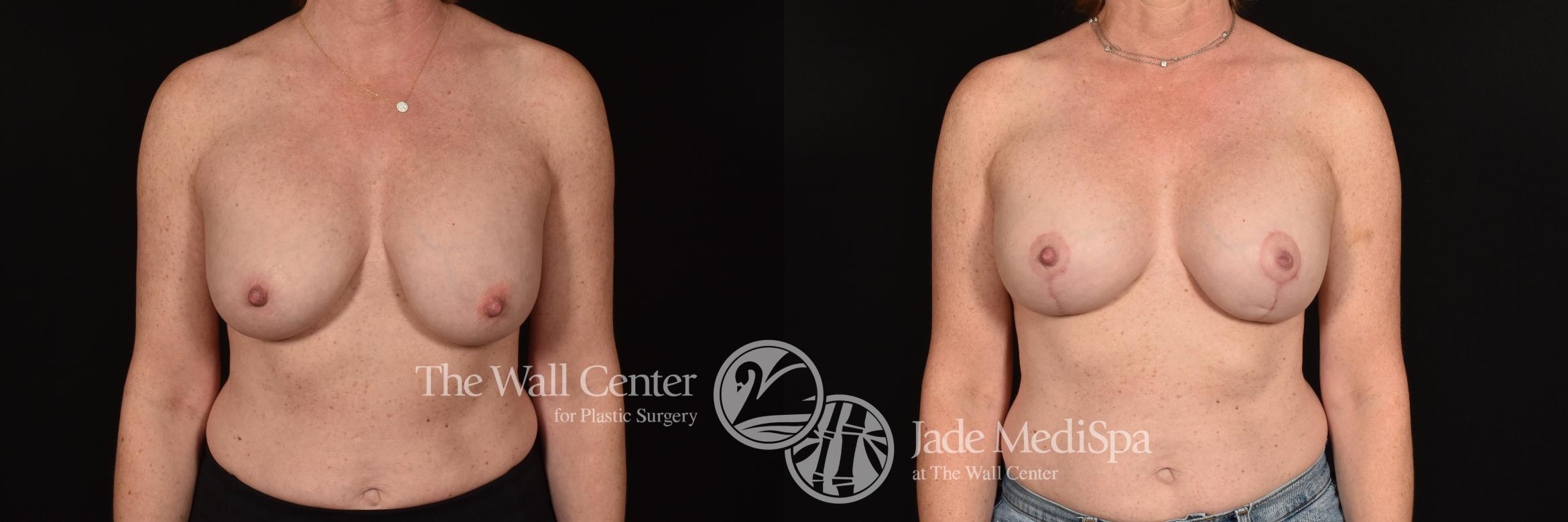Before & After Breast Implant Exchange Case 1194 Front View in Shreveport, LA