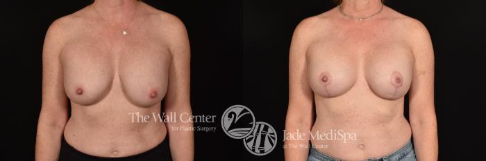 Before & After Breast Implant Exchange Case 1194 Front View in Shreveport, LA