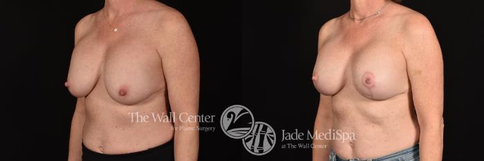 Before & After Breast Implant Exchange Case 1194 Left Oblique View in Shreveport, LA