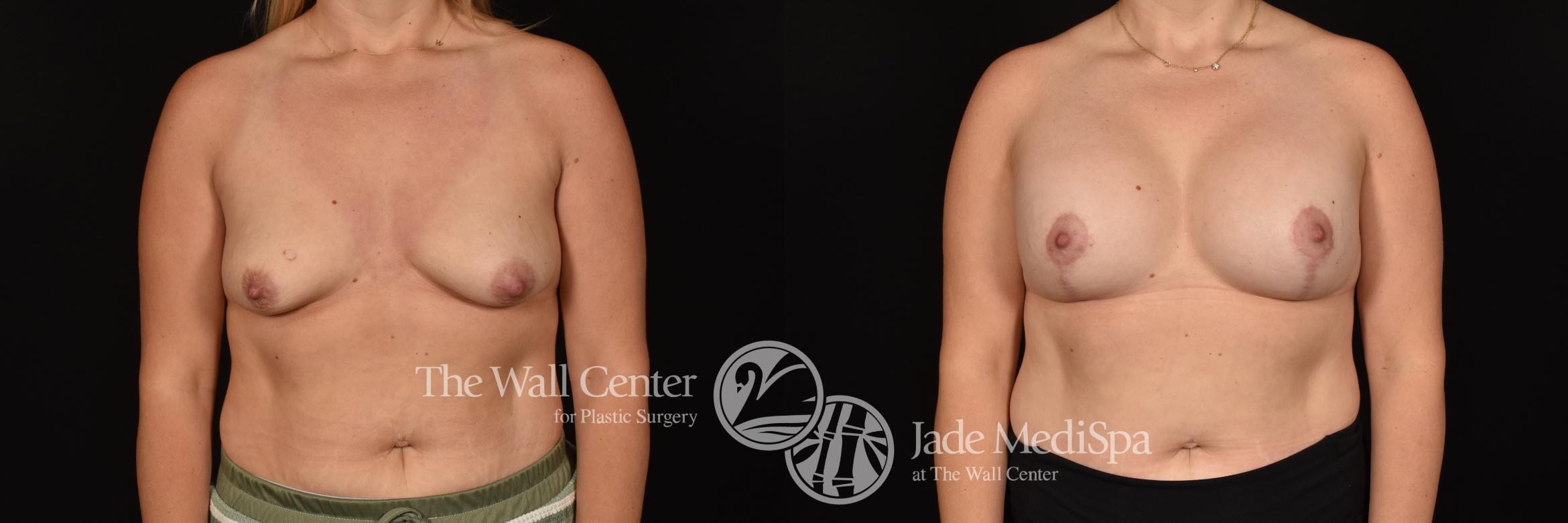 Before & After Breast Augmentation with Lift Case 1205 Front View in Shreveport, LA