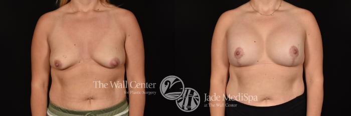 Before & After Breast Augmentation with Lift Case 1205 Front View in Shreveport, LA