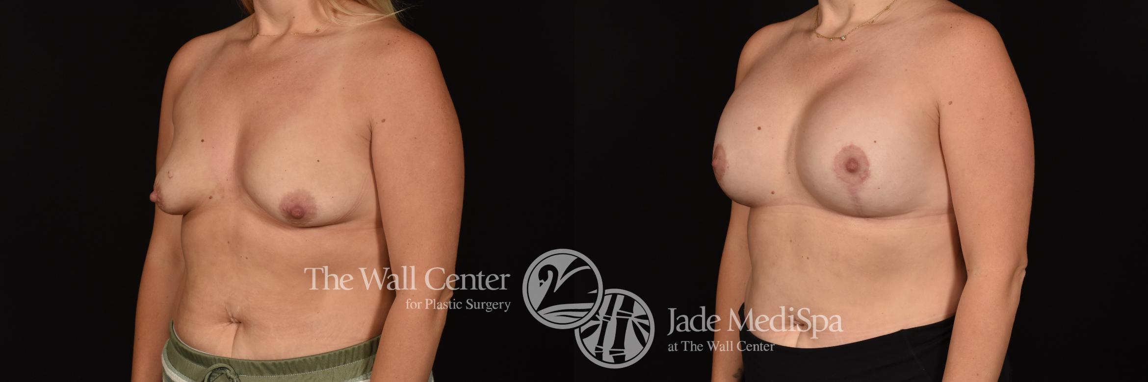 Before & After Breast Augmentation with Lift Case 1205 Left Oblique View in Shreveport, LA