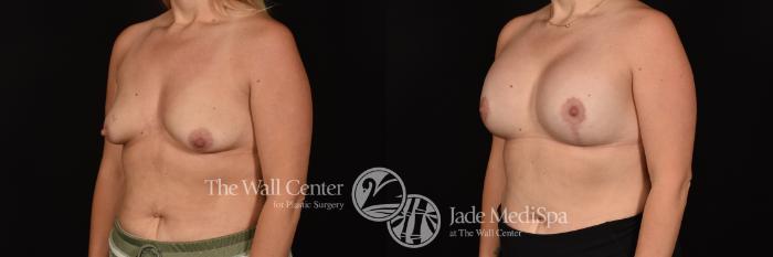 Before & After Breast Augmentation with Lift Case 1205 Left Oblique View in Shreveport, LA