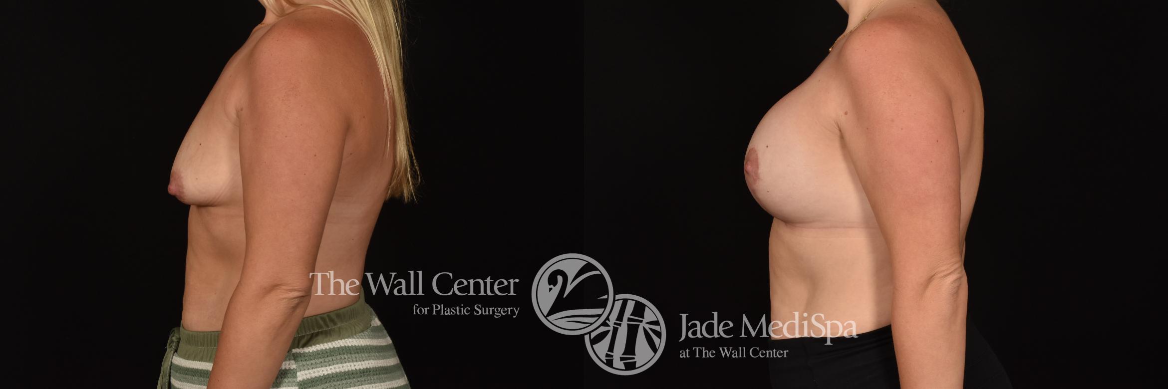 Before & After Breast Augmentation with Lift Case 1205 Left Side View in Shreveport, LA