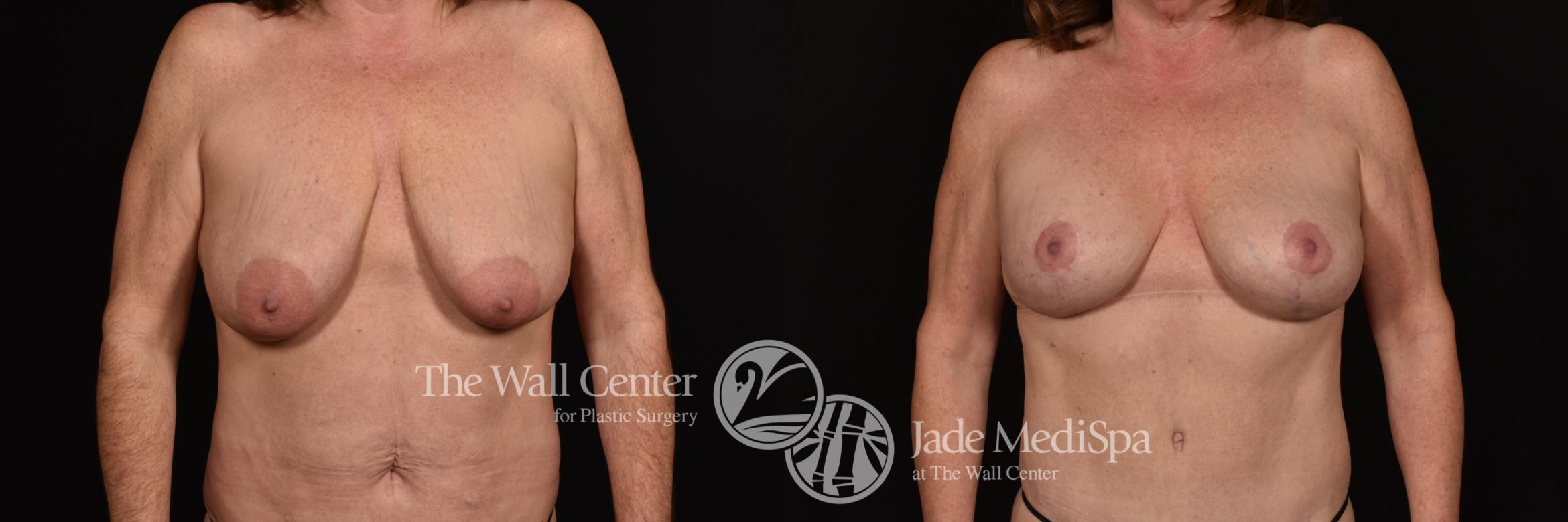 Before & After Breast Augmentation with Lift Case 1211 Front View in Shreveport, LA