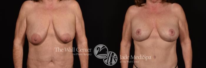 Before & After Breast Augmentation with Lift Case 1211 Front View in Shreveport, LA