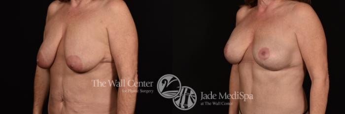 Before & After Breast Augmentation with Lift Case 1211 Left Oblique View in Shreveport, LA