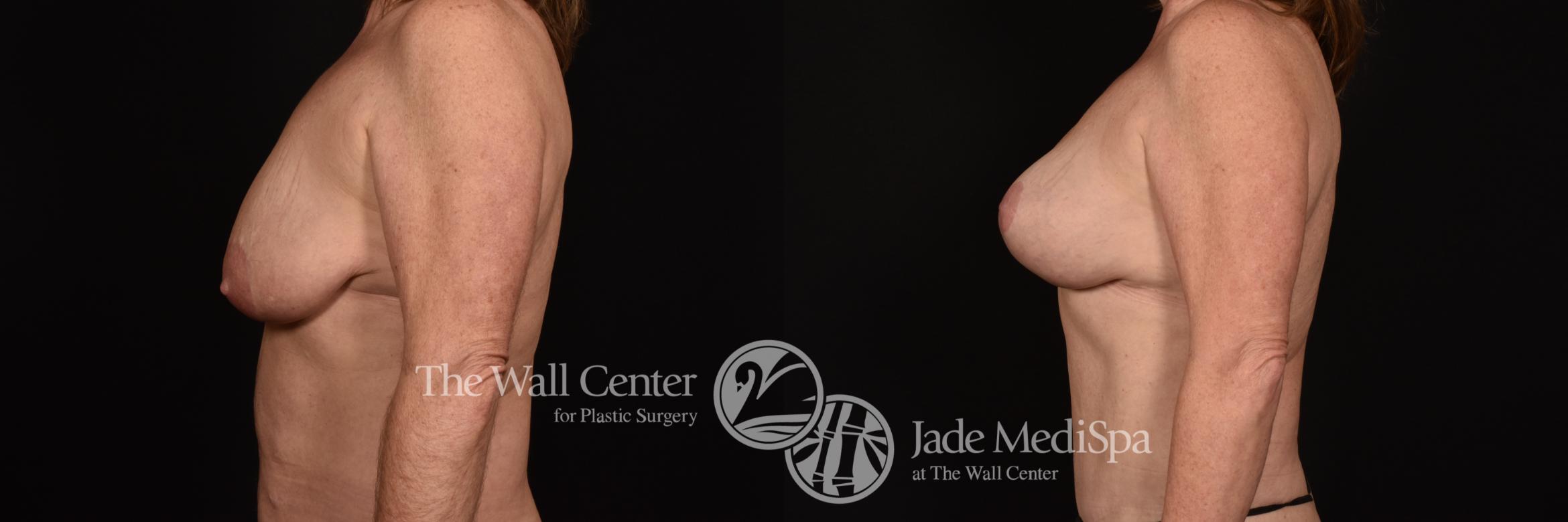 Before & After Breast Augmentation with Lift Case 1211 Left Side View in Shreveport, LA