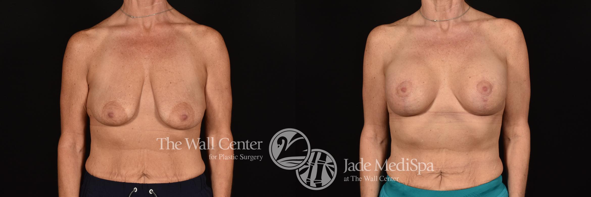Before & After Breast Augmentation with Lift Case 1214 Front View in Shreveport, LA