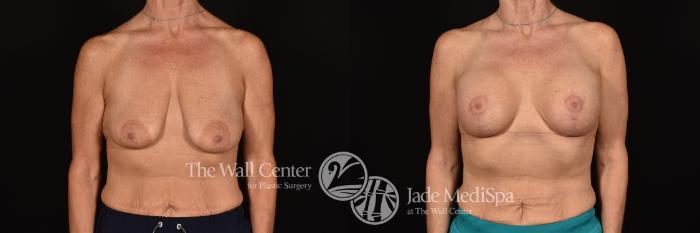 Before & After Breast Augmentation with Lift Case 1214 Front View in Shreveport, LA