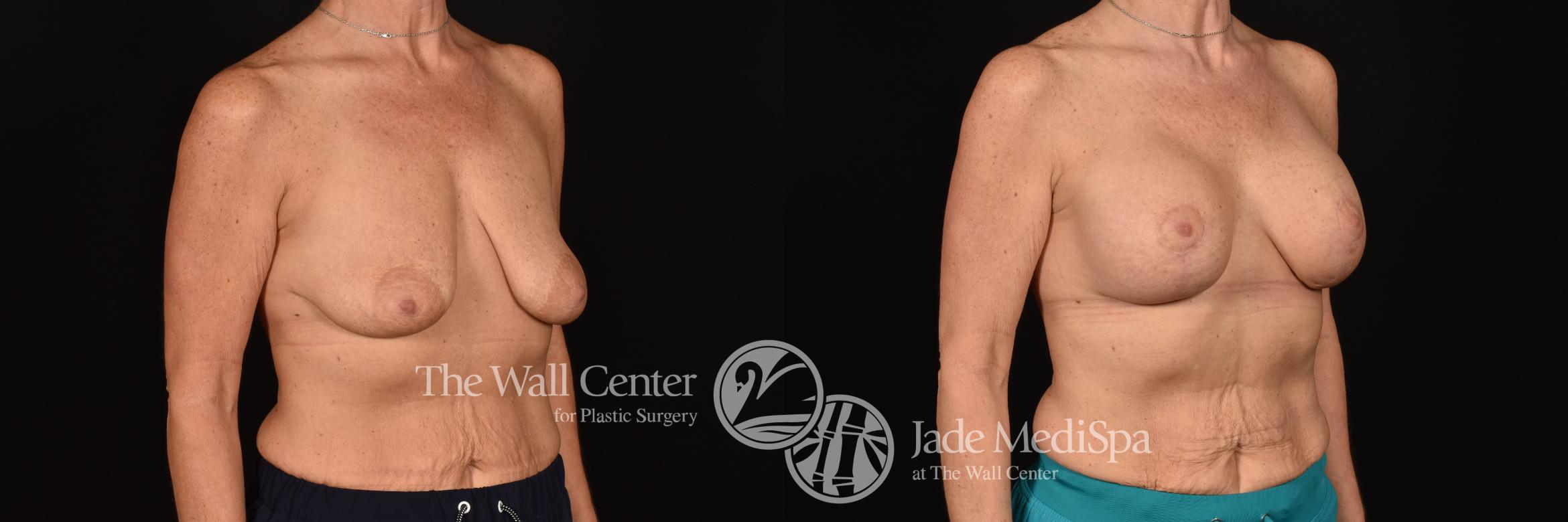 Before & After Breast Augmentation with Lift Case 1214 Right Oblique View in Shreveport, LA