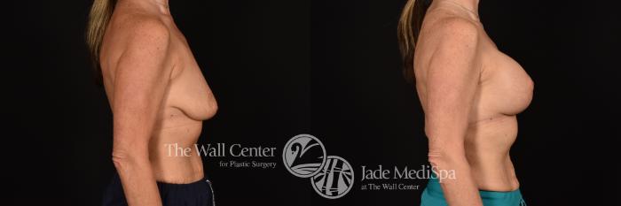 Before & After Breast Augmentation with Lift Case 1214 Right Side View in Shreveport, LA