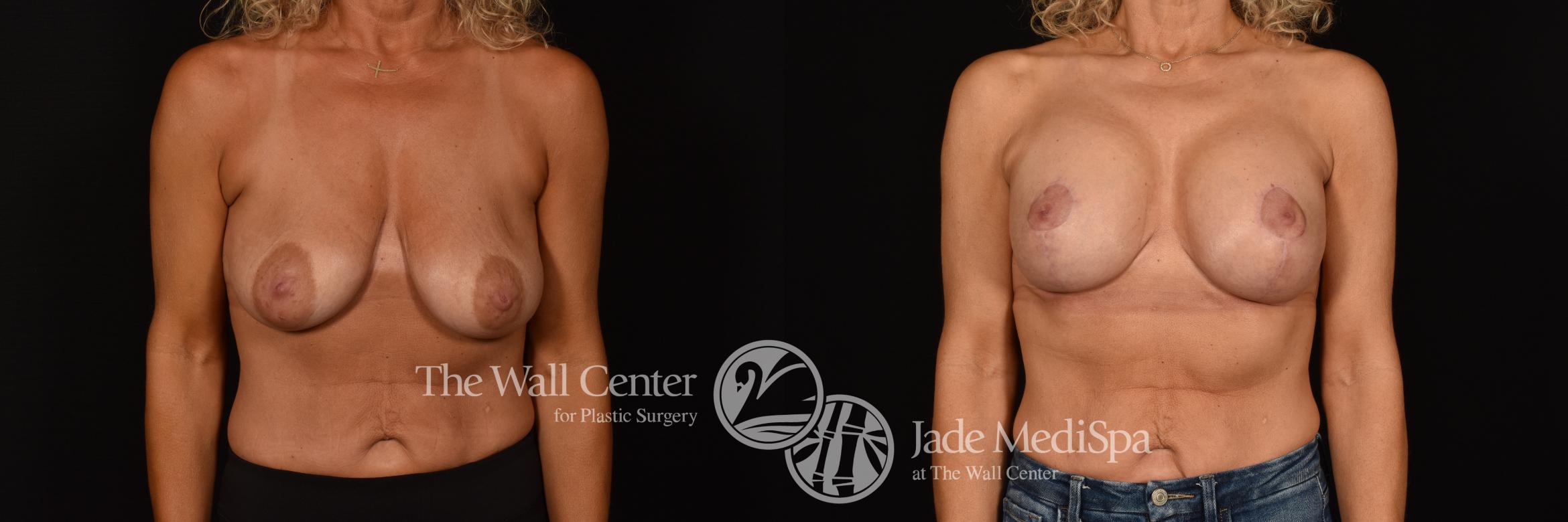Before & After Breast Augmentation with Lift Case 1215 Front View in Shreveport, LA